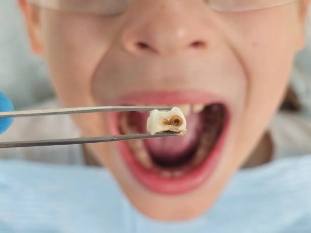 Best Broken or Chipped Tooth Repair in Kewaunee, WI